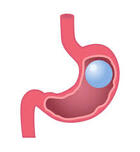 How Does a Gastric Balloon Work?
