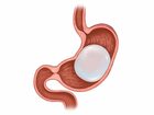 How Much Weight Can You Expect to Lose with the Elipse Balloon?