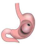 Are There Any Dietary Restrictions with a Gastric Balloon?